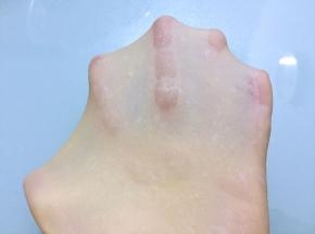 直到揉到扩展阶段，全程共45分钟